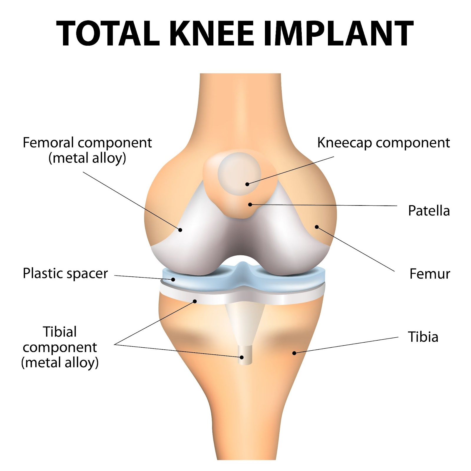 Best robotic bilateral knee replacement doctor in Jaipur